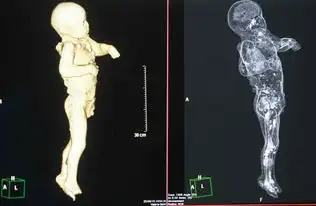 庞贝古城木乃伊接受ct扫描死前惊恐表情曝光组图