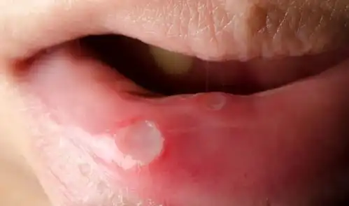 口腔溃疡反复发作,到底是什么原因导致的