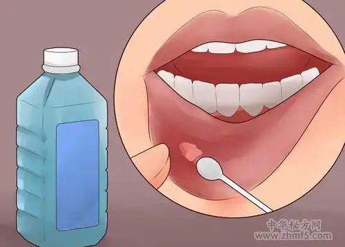 一夜治愈口腔溃疡妙法,口腔溃疡5种常用药