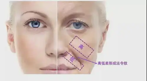 法令纹焦虑如果保持30年不做表情,真的可以预防法令纹么